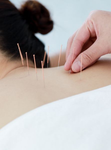 Akupunktur Behandlung